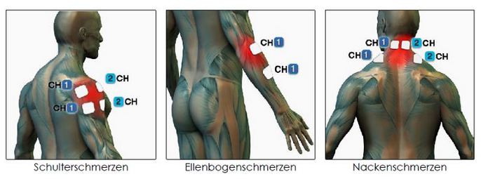 Elektroden Positionen F R Ems Und Mikrostrom Anwendungen